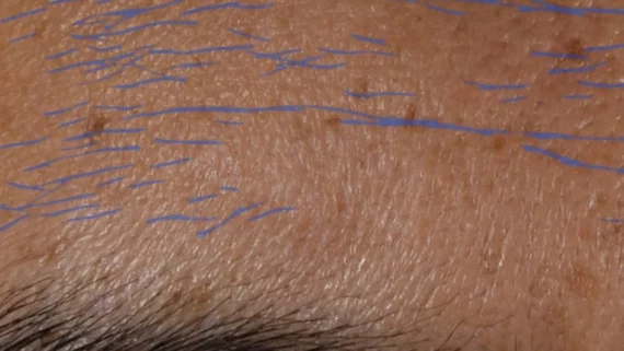 forehead wrinkles on man