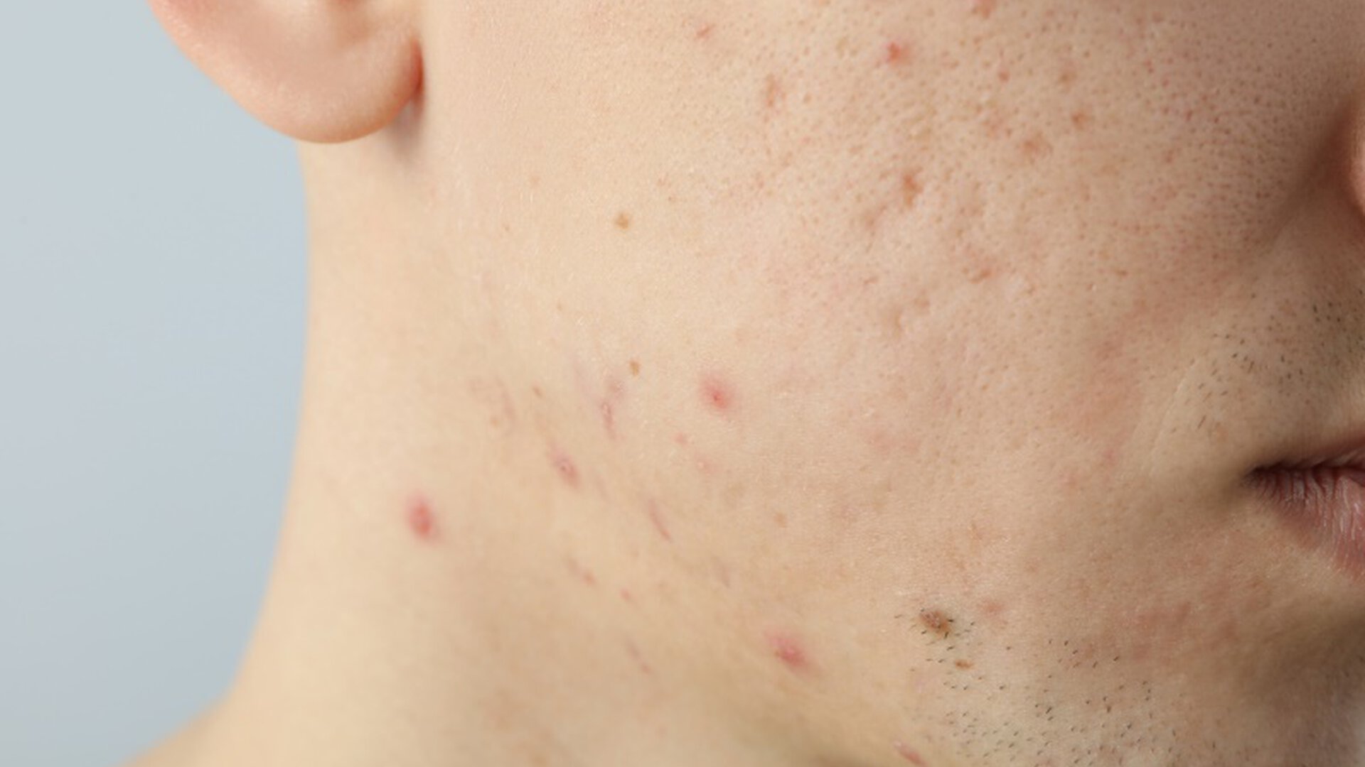 Altersakne bei Mannern: Darstellung Biotherm T-Pur-Produkt