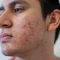Person mit Akne im Gesicht steht in einem Innenraum. Nahaufnahme des rechten Gesichtsbereichs.