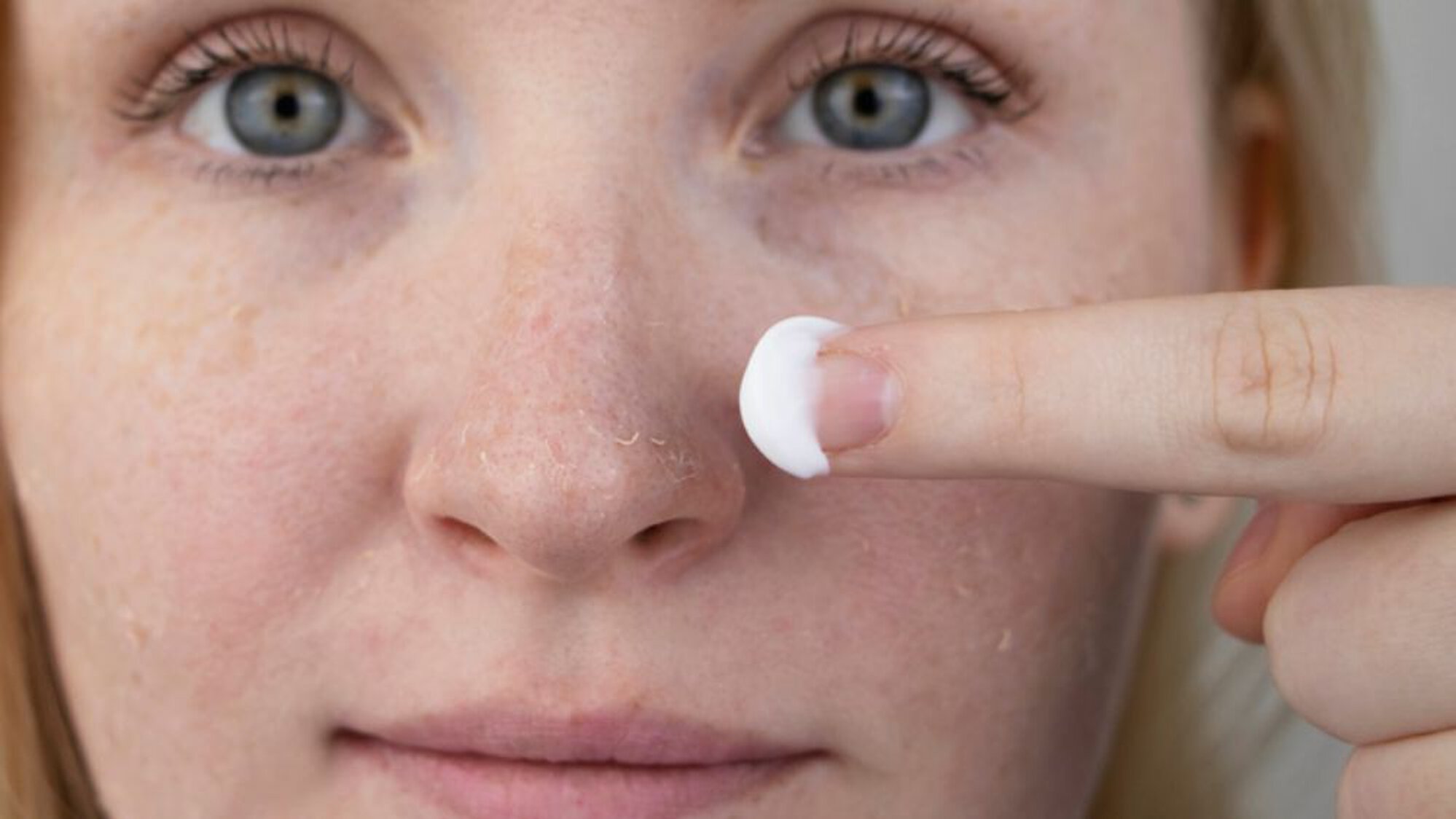 Frau mit trockener Haut im Gesicht